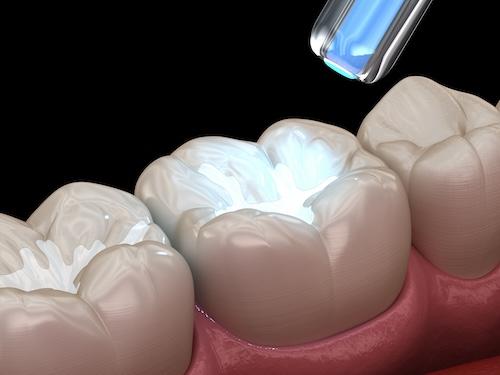 An illustration of a dental sealant being applied